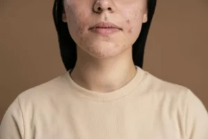 Acne